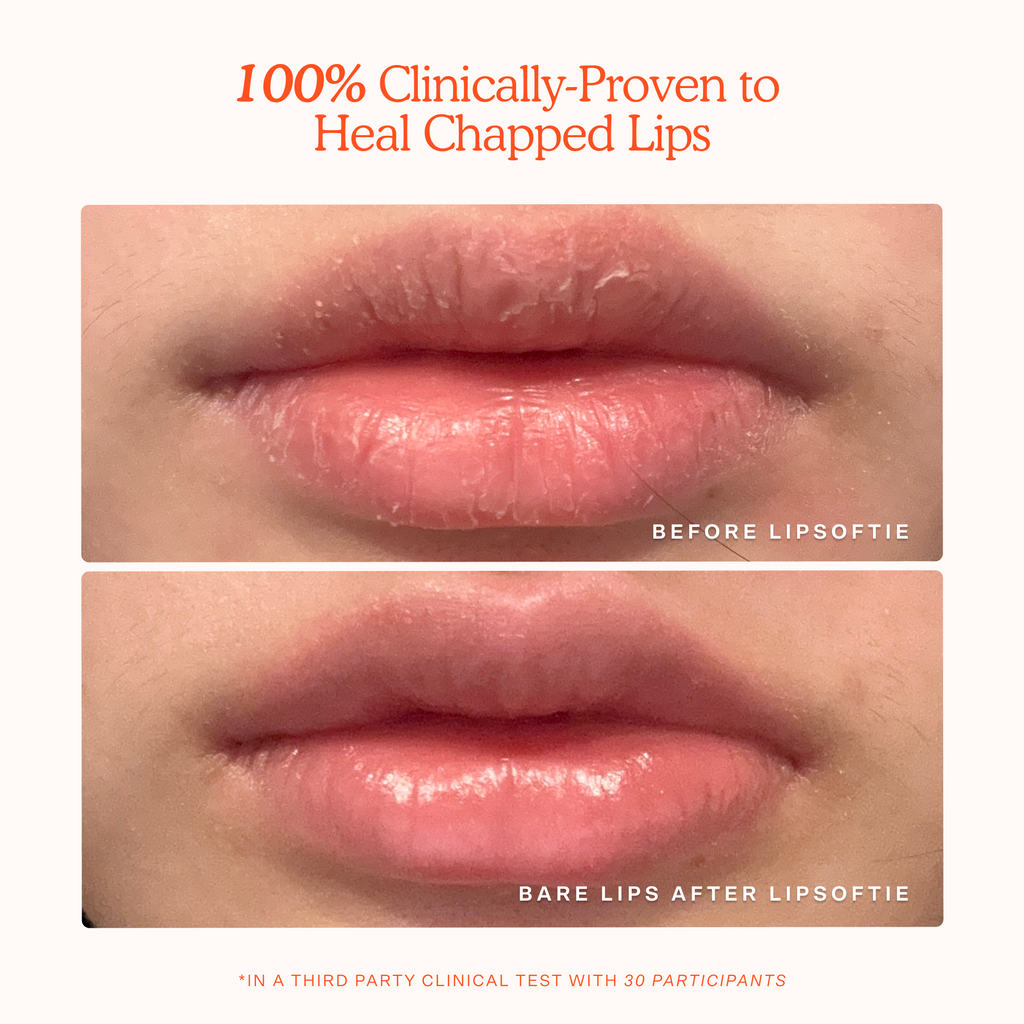 LipSoftie® Lip Treatment Z2