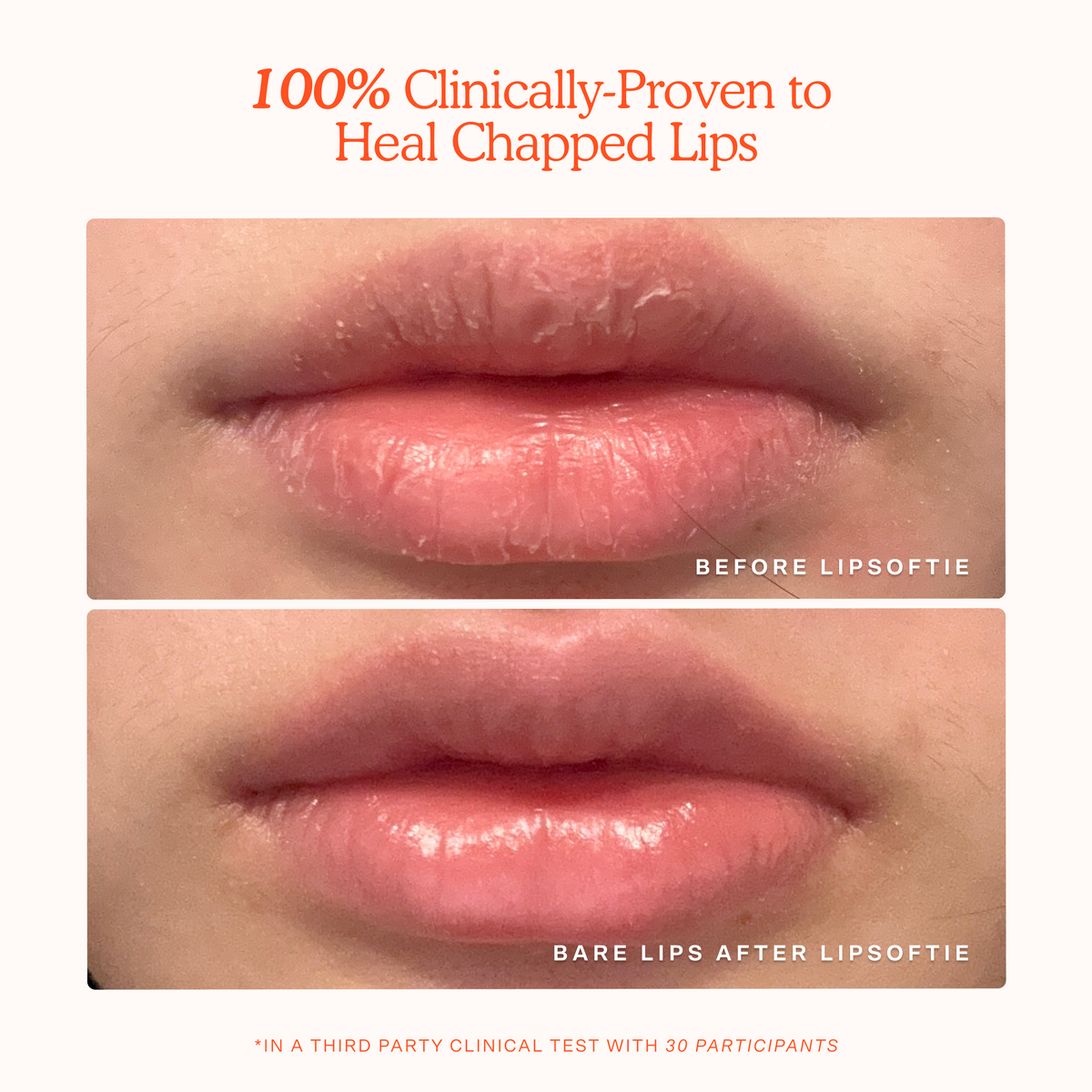 LipSoftie® Lip Treatment Z2