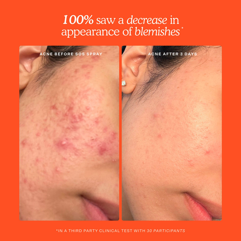 SOS 3-Step Skincare Set O3