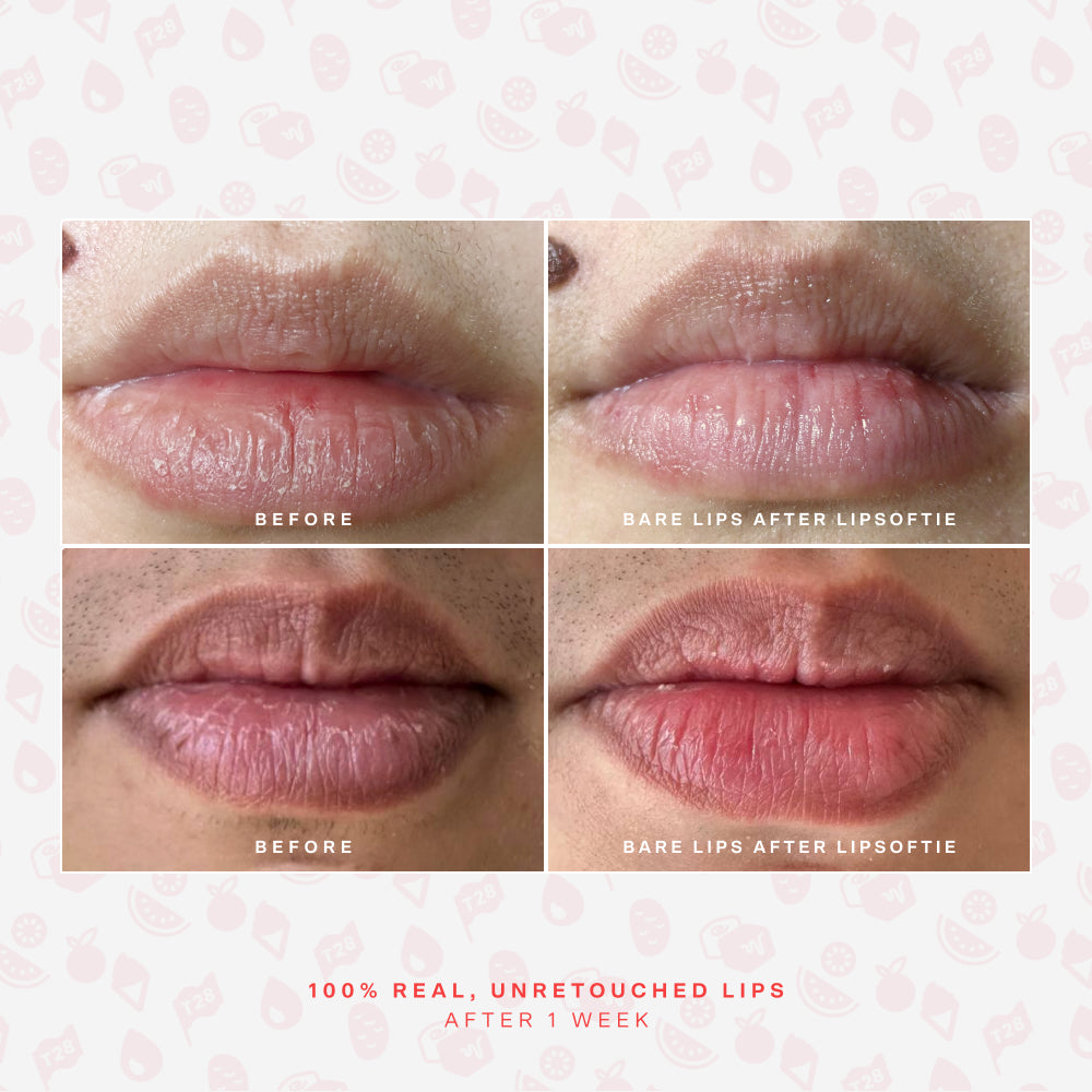 SOS LipSoftie® Lip Treatment S1