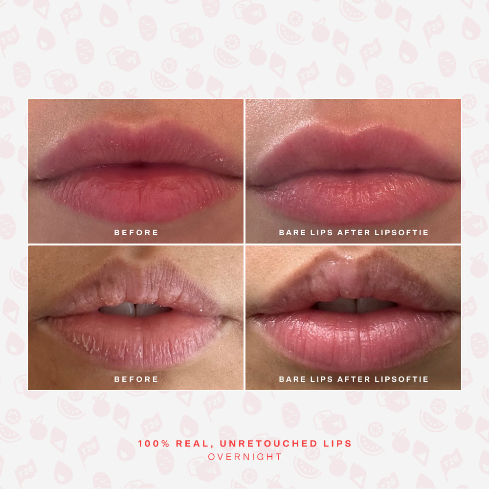 SOS LipSoftie® Lip Treatment S1